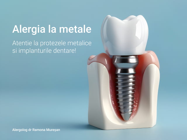 Alergia la metale: atenție la proteze și implanturi dentare